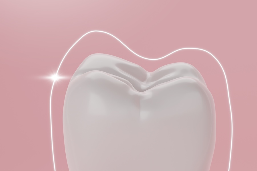 fluoride treatment