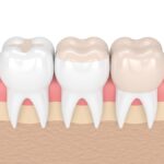 dental filling vs dental crown, dental filling, dental inlay, dental onlay, dental crown