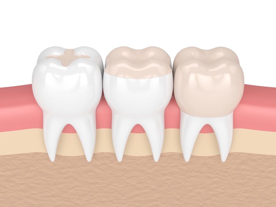 dental filling vs dental crown, dental filling, dental inlay, dental onlay, dental crown